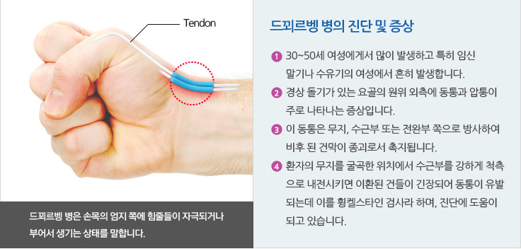 드꾀르벵 병의 진단 및 증상			
																				  30~50세 여성에게서 많이 발생하고 특히 임신 
																				  말기나 수유기의 여성에서 흔히 발생합니다
																				  경상 돌기가 있는 요골의 원위 외측에 동통과 압통이 
																				  주로 나타나는 증상입니다.
																				  이 동통은 무지, 수근부 또는 전완부 쪽으로 방사하여 
																				  비후 된 건막이 종괴로서 촉지됩니다.
																				  환자의 무지를 굴곡한 위치에서 수근부를 강하게 척측
																				  으로 내전시키면 이환된 건들이 긴장되어 동통이 유발
																				  되는데 이를 휭켈스타인 검사라 하며, 진단에 도움이 
																				  되고 있습니다.