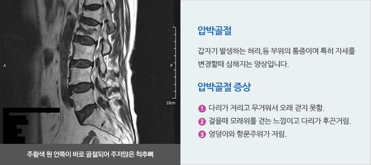 압박골절 
	갑자기 발생하는 허리,등 부위의 통증이며 특히 자세를 
	변경할때 심해지는 양상입니다.
	압박골절 증상
	다리가 저리고 무거워서 오래 걷지 못함.
	걸을때 모래위를 걷는 느낌이고 다리가 후끈거림.
	엉덩이와 항문주위가 저림.
	