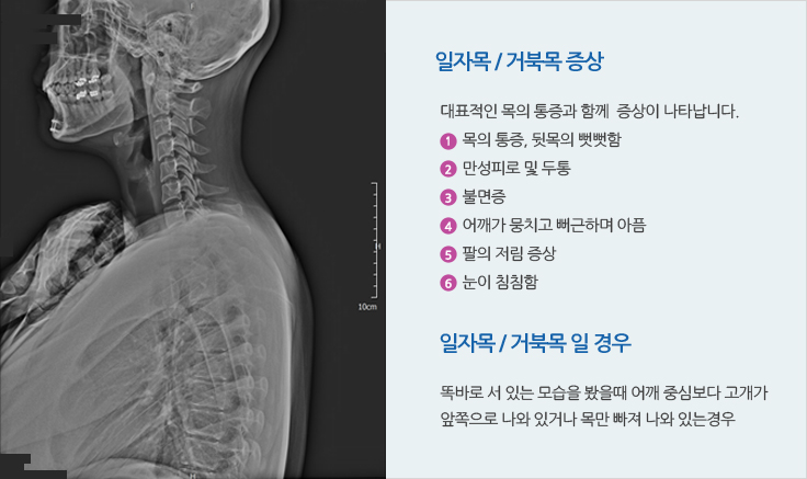 일자목 / 거북목 증상
		대표적인 목의 통증과 함께  증상이 나타납니다.
		목의 통증, 뒷목의 뻣뻣함
		만성피로 및 두통
		불면증
		어깨가 뭉치고 뻐근하며 아픔
		팔의 저림 증상
		눈이 침침함
		일자목 / 거북목 일 경우는
		똑바로 서 있는 모습을 봤을때 어깨 중심보다 고개가 
		앞쪽으로 나와 있거나 목만 빠져 나와 있는경우